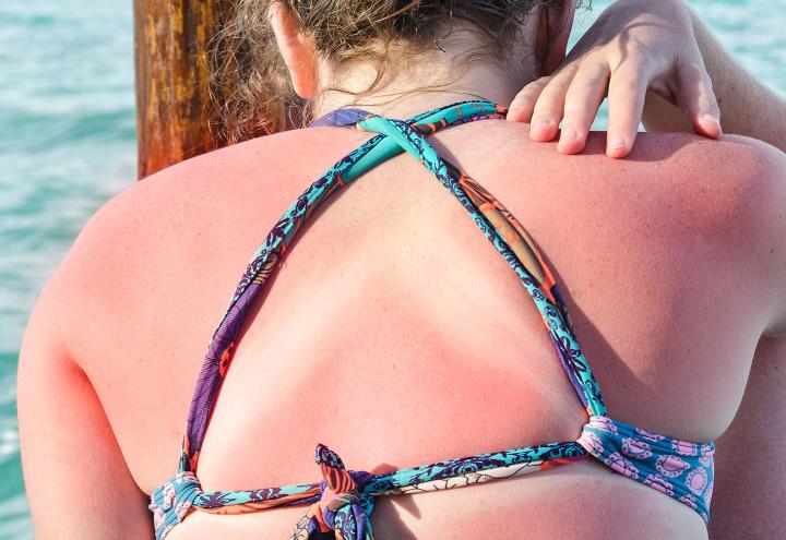 Schnelle Hilfe bei Sonnenbrand